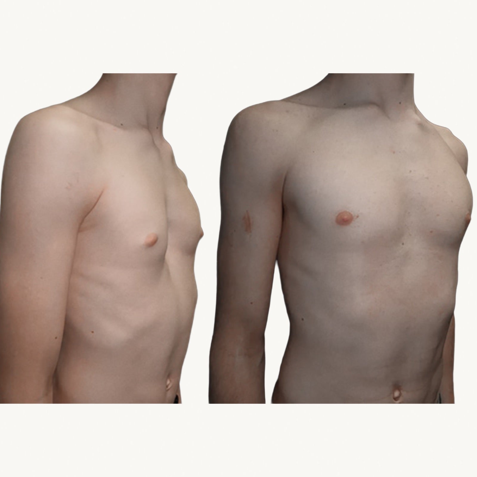 Pectus excavatum before and after non-surgical correction with the FormaChest vacuum bell, three-quarter view