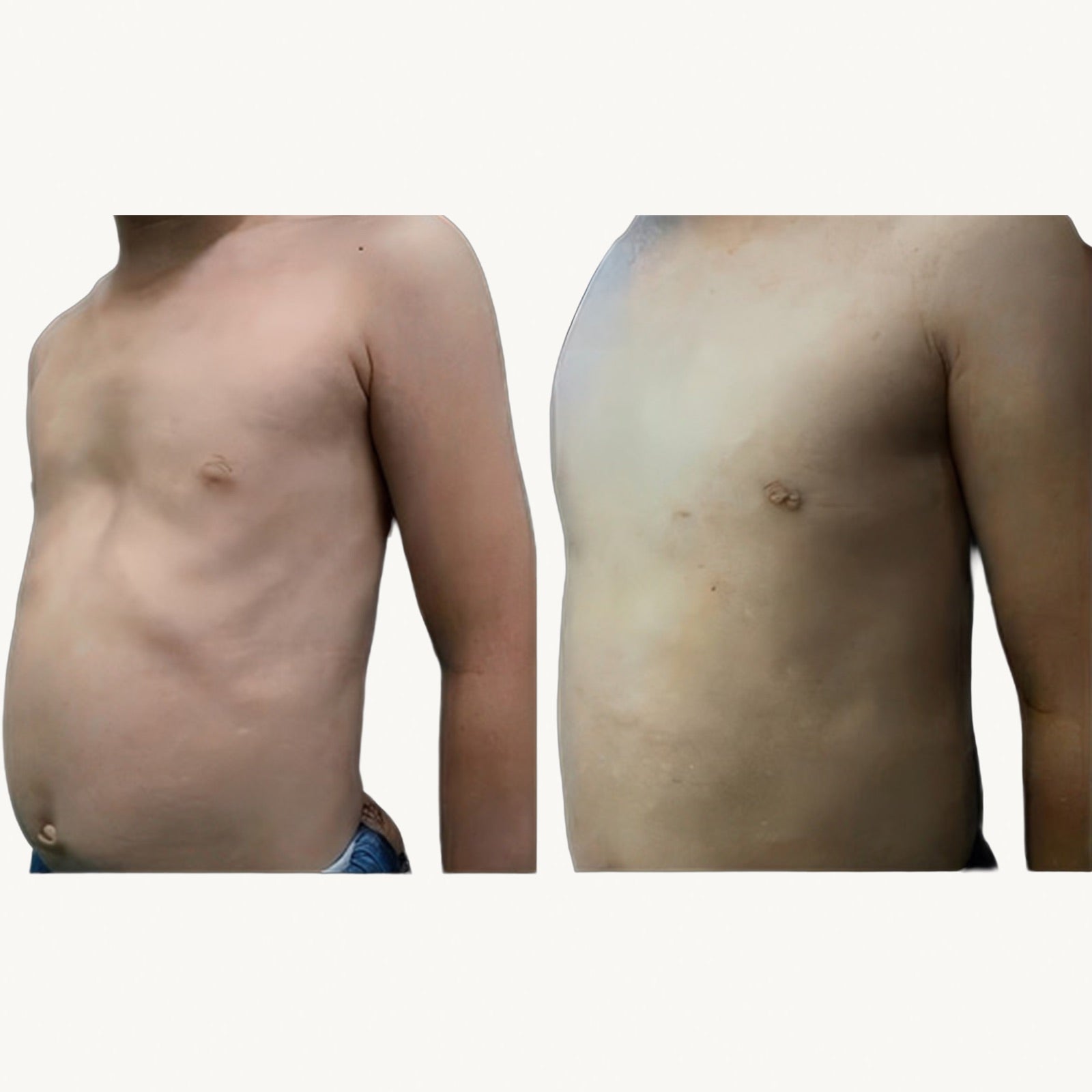 Pectus excavatum before and after non-surgical correction with the FormaChest vacuum bell, side profile view