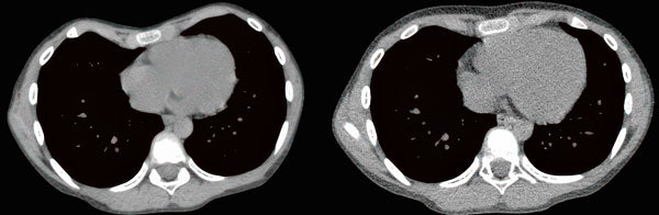 Chest CT scan showing pectus excavatum depth reduction after vacuum bell therapy
