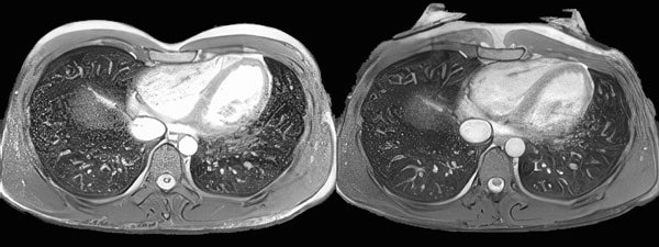 Pectus excavatum CT scan documenting sternum correction with the FormaChest vacuum bell