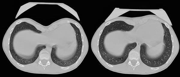 Before and after chest CT confirming pectus excavatum improvement with vacuum bell therapy