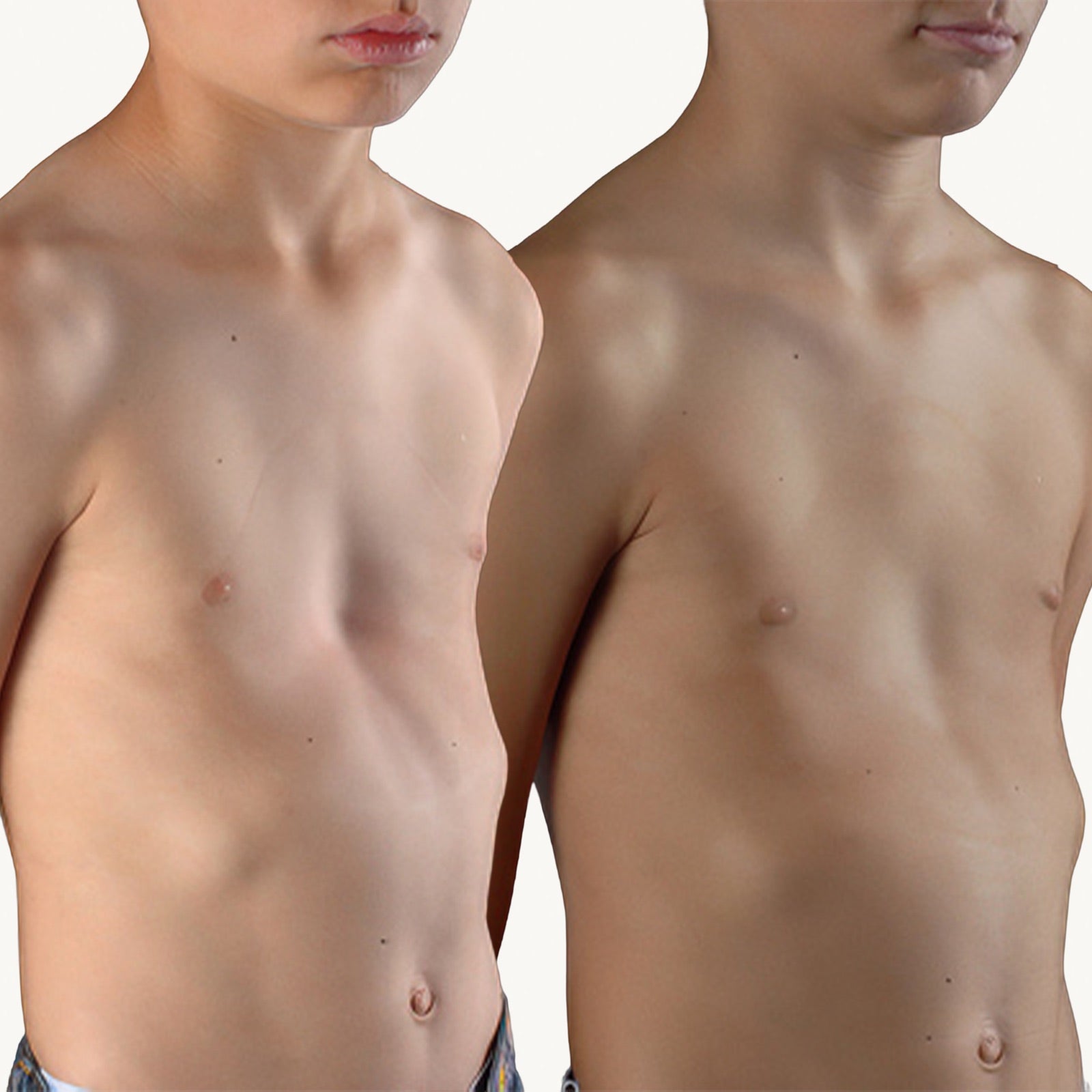 Pectus excavatum before and after non-surgical correction with the FormaChest vacuum bell, front view