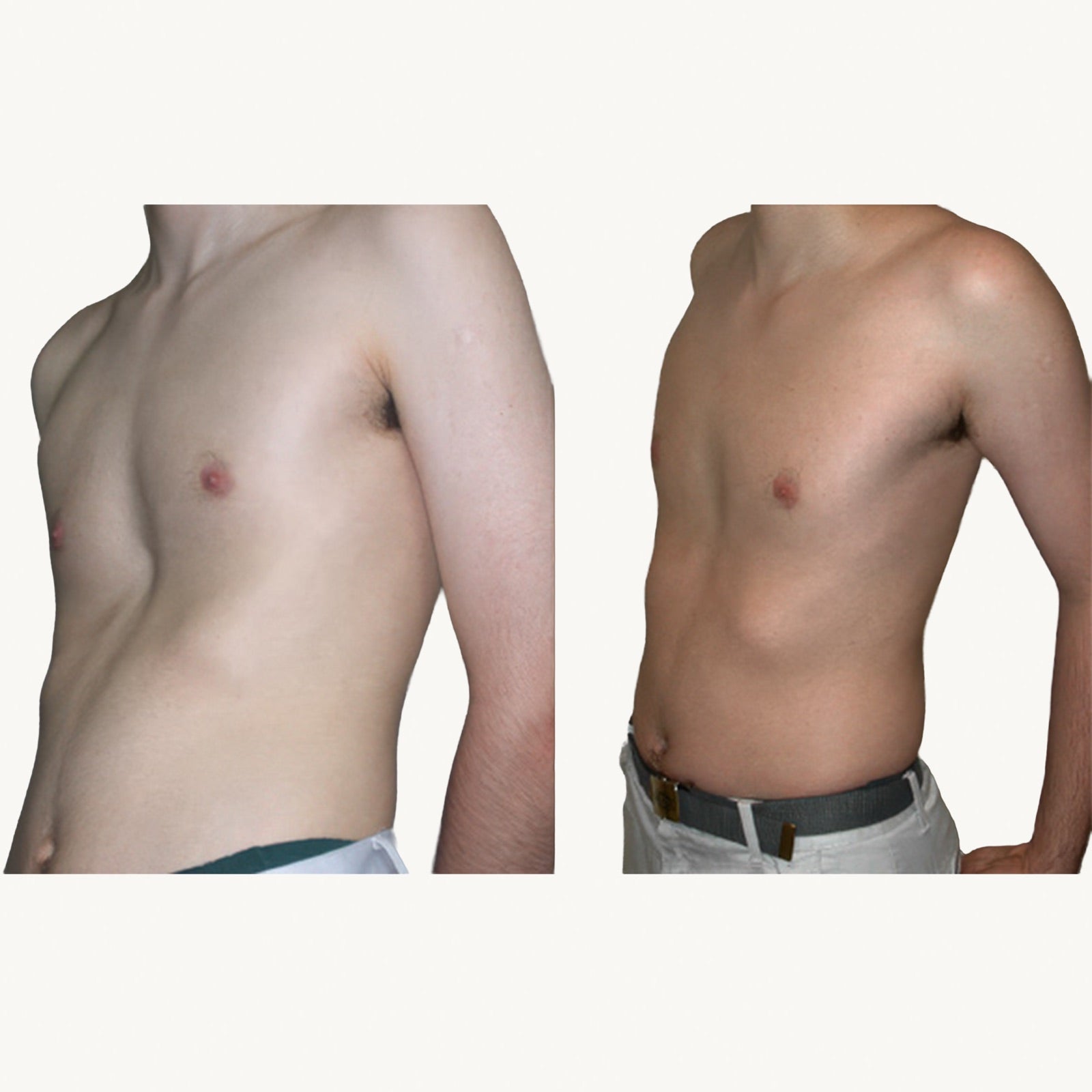 Pectus excavatum before and after non-surgical correction with the FormaChest vacuum bell, lateral view