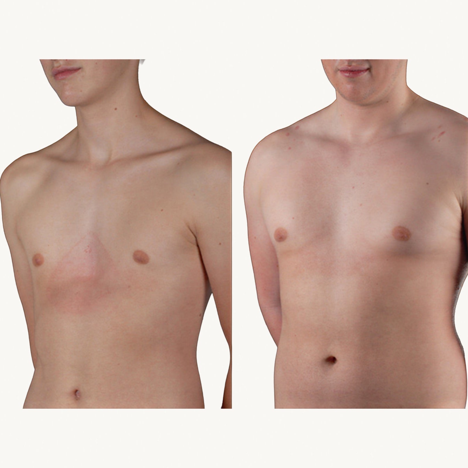Pectus excavatum before and after non-surgical correction with the FormaChest vacuum bell, frontal view
