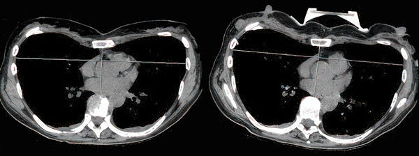 Axial chest CT scan before and after non-surgical vacuum bell correction of pectus excavatum, Haller index comparison