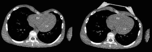 Before and after CT scan of non-surgical pectus excavatum correction with a vacuum bell