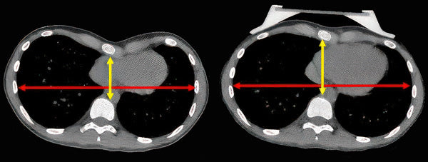 CT cross-section before and after vacuum bell treatment for pectus excavatum